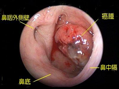 鼻咽癌南方高发之谜，解析地域与鼻咽癌的关系